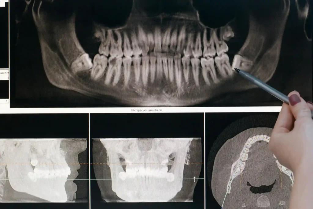 why choose us for wisdom teeth extractions