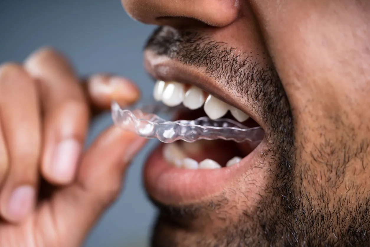 man using teeth aligners