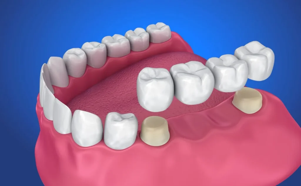 am i a good candidate for a dental bridge