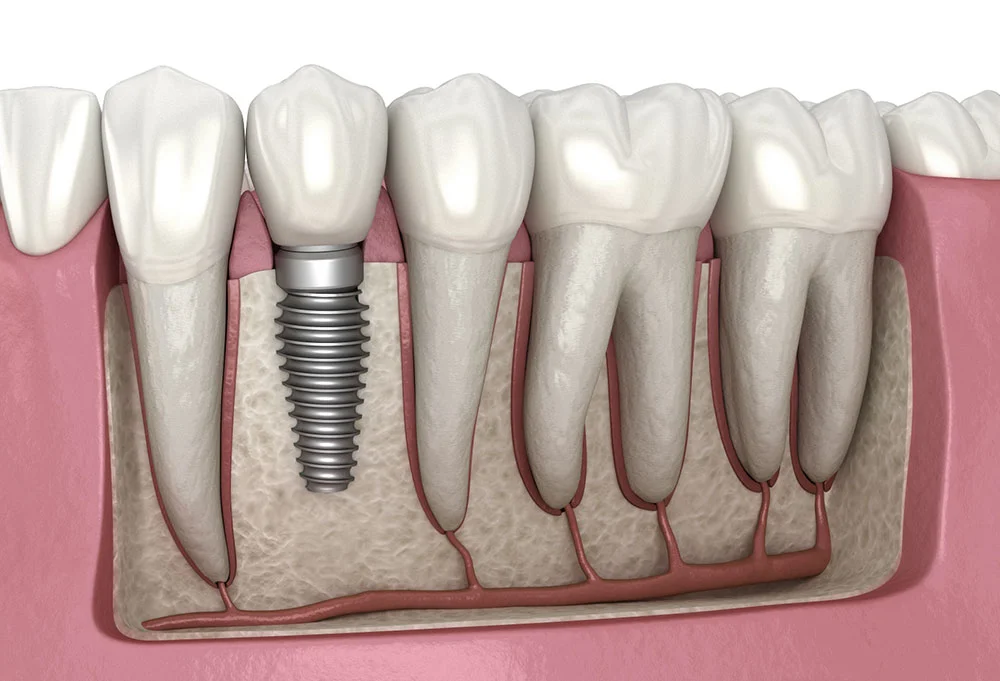 dental implants in south gate