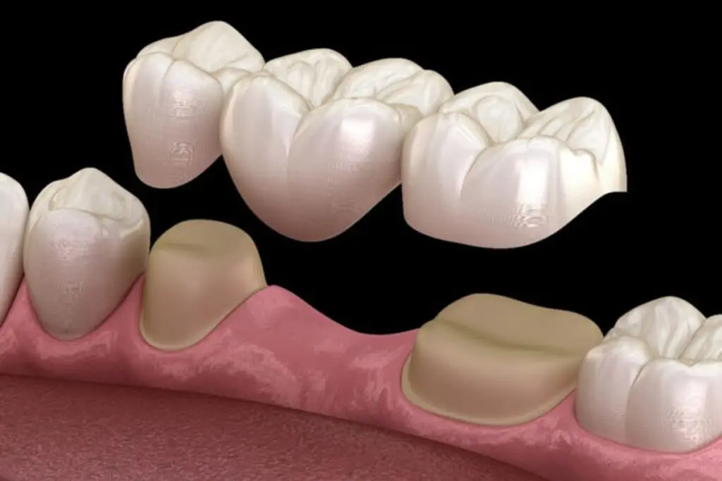 how long do dental bridges last