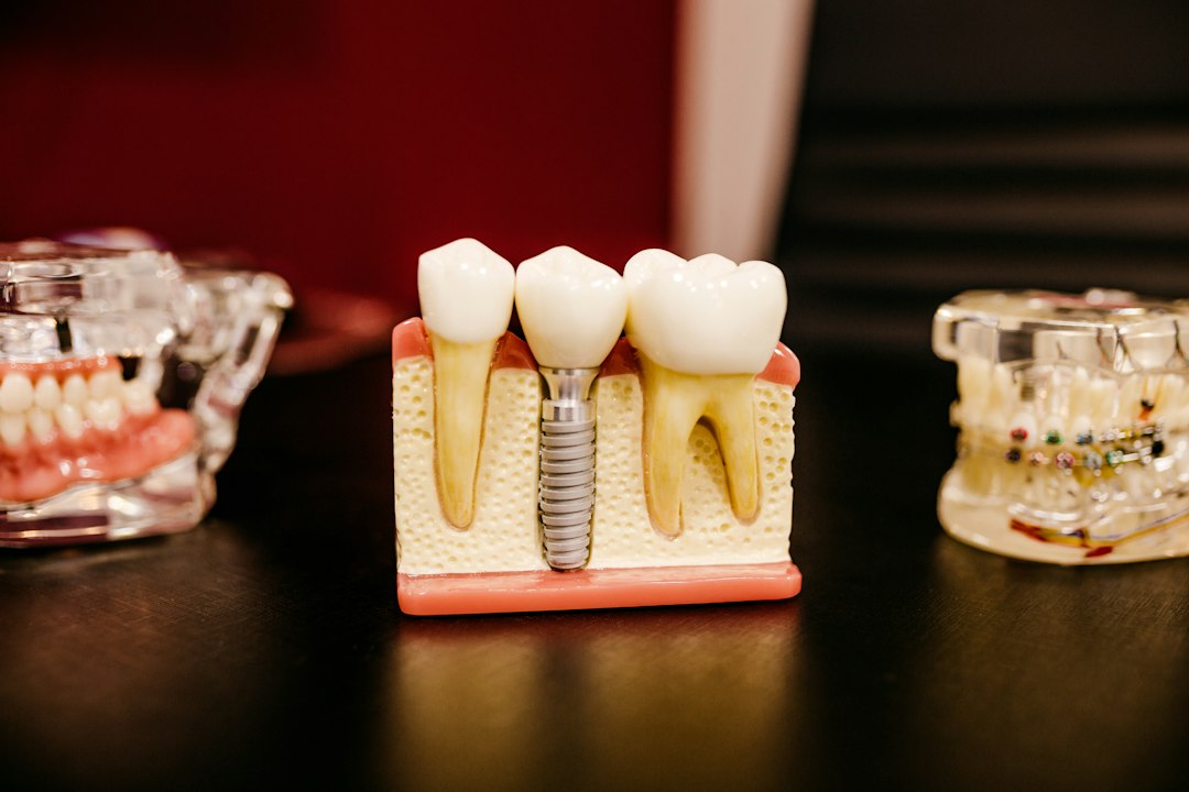 Dental implant model showing teeth and jaw