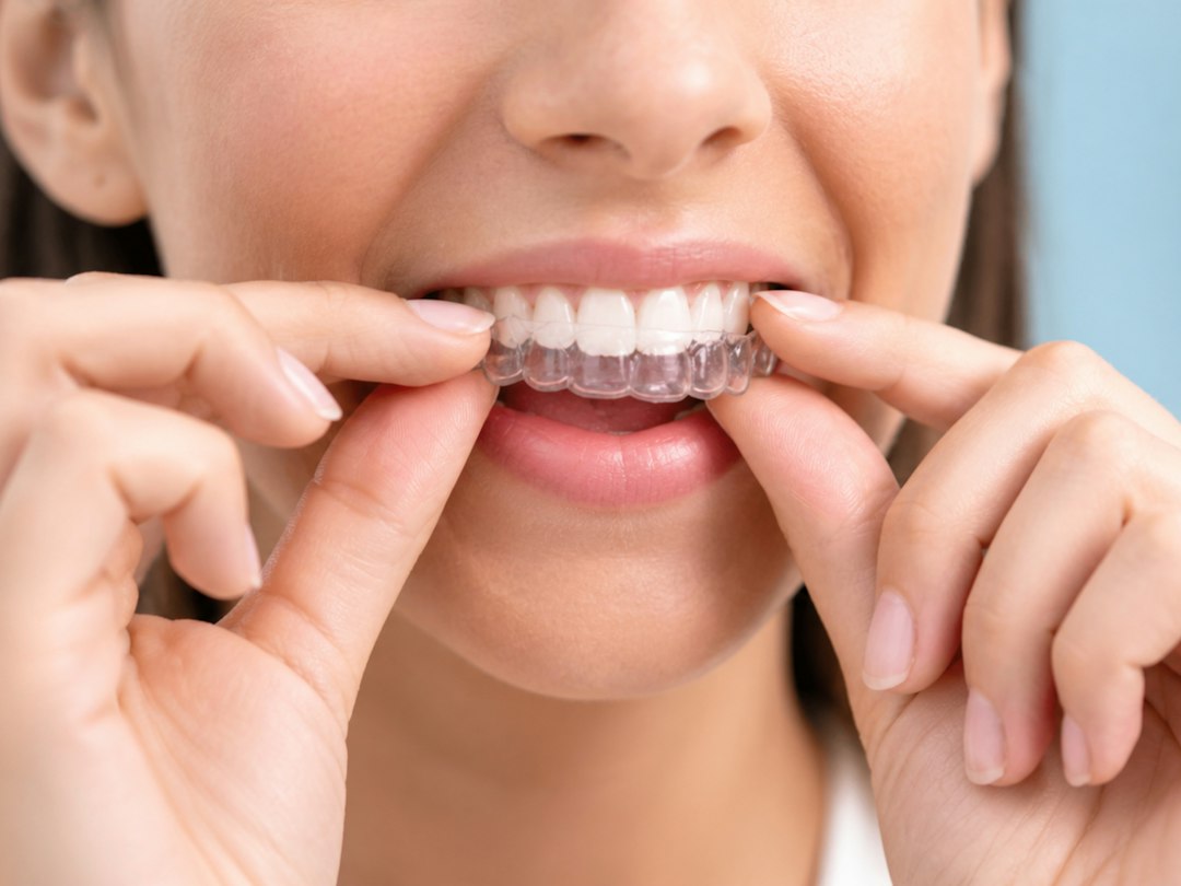 Woman fitting a clear Invisalign aligner onto her teeth